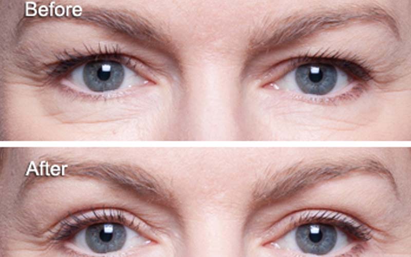 Double eyelids and Hooded eyes