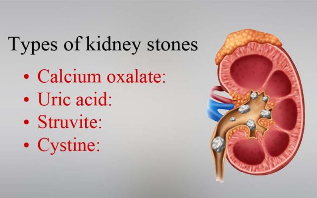 Types of kidney stones